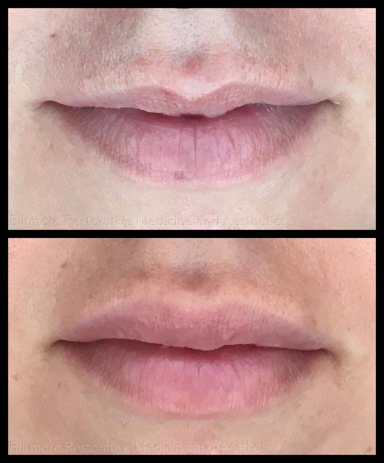 Asheville Medspa models lips before and after