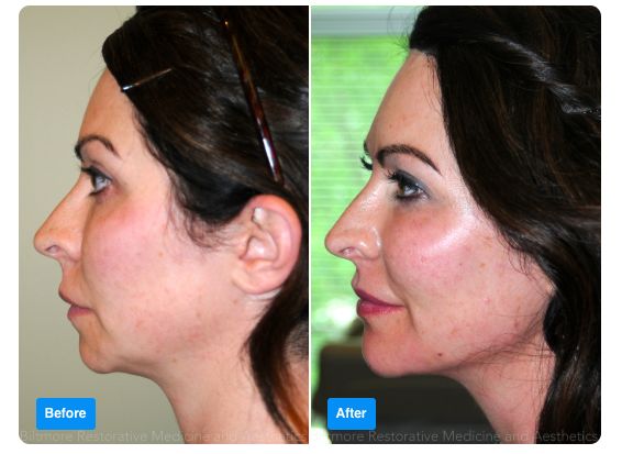 Asheville Medspa model before and after