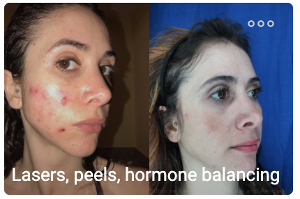 Asheville bioidentical hormone replacement therapy model before and after