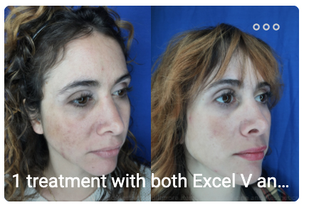 Asheville enlighten by cutera model before and after