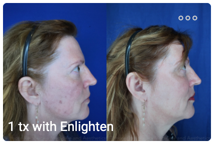 Asheville enlighten by cutera model before and after