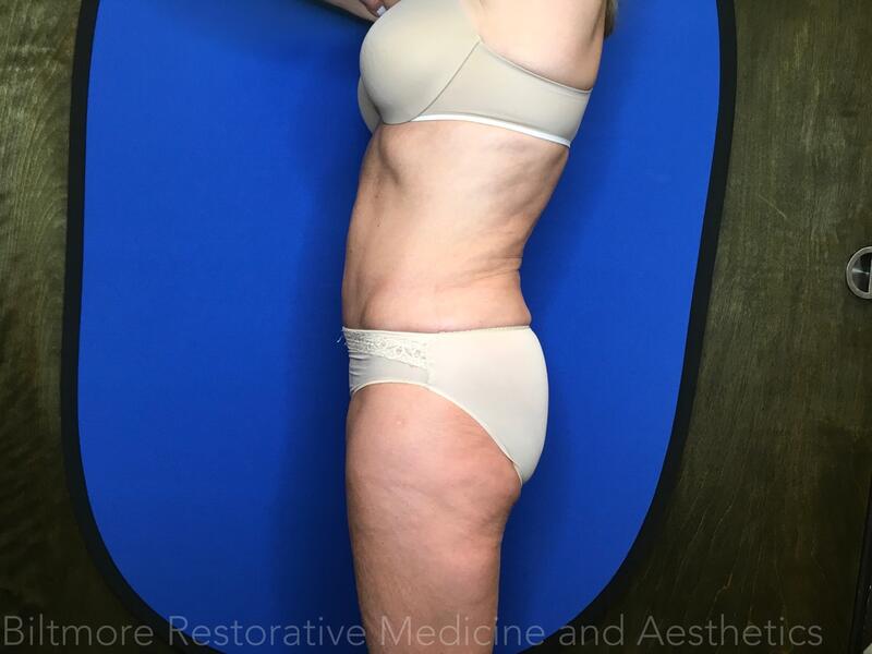 Body Sculpting - Combination Treatments Before & After Image