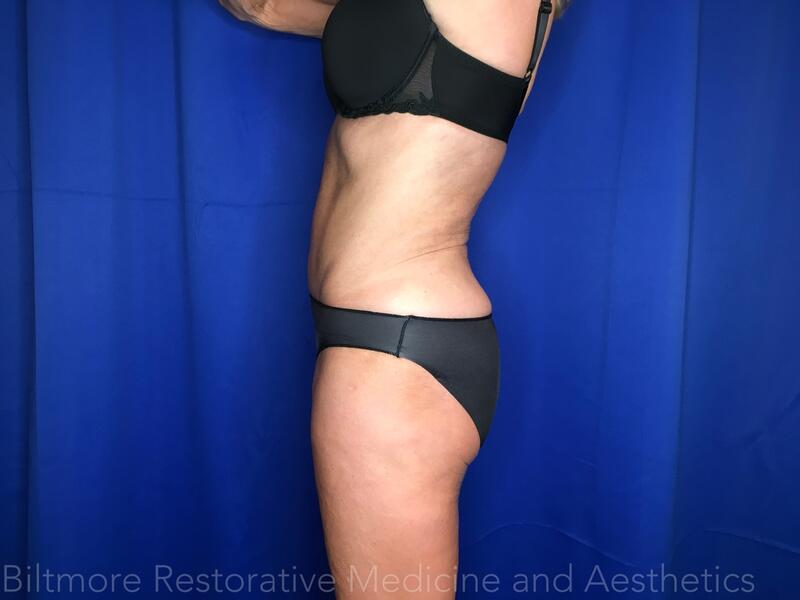 Body Sculpting - Combination Treatments Before & After Image