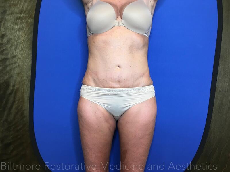 Body Sculpting - Combination Treatments Before & After Image