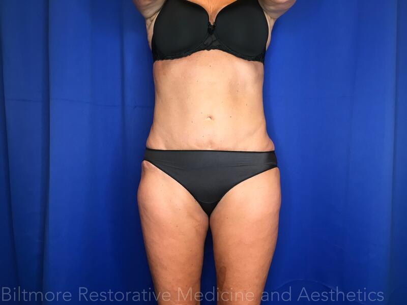 Body Sculpting - Combination Treatments Before & After Image