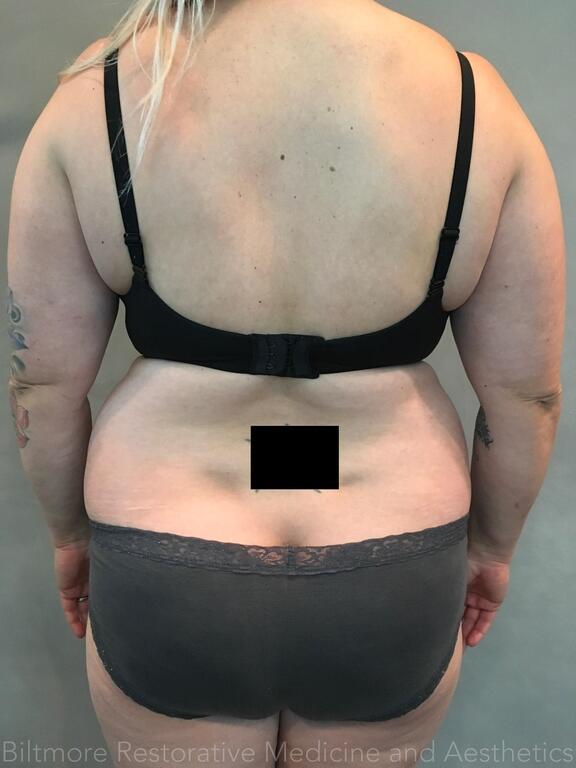 Body Sculpting - Combination Treatments Before & After Image