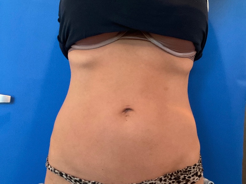 Body Sculpting - Combination Treatments Before & After Image