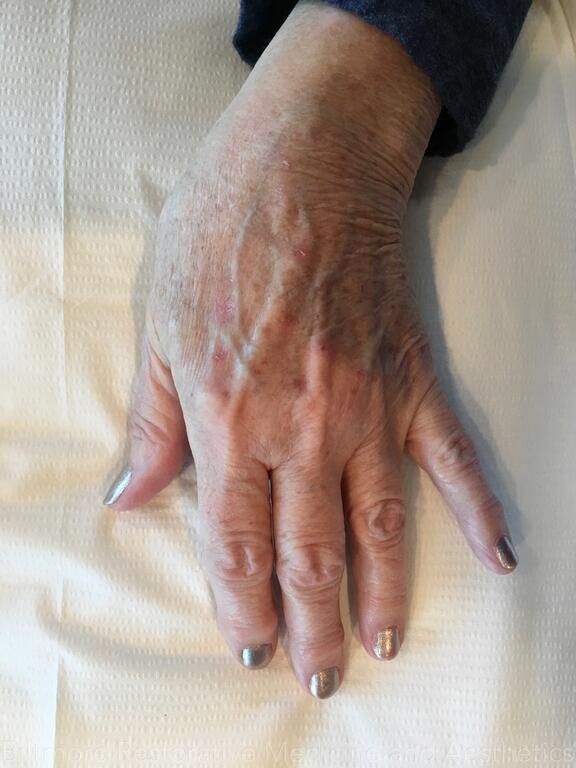 Hand Rejuvenation Before & After Image