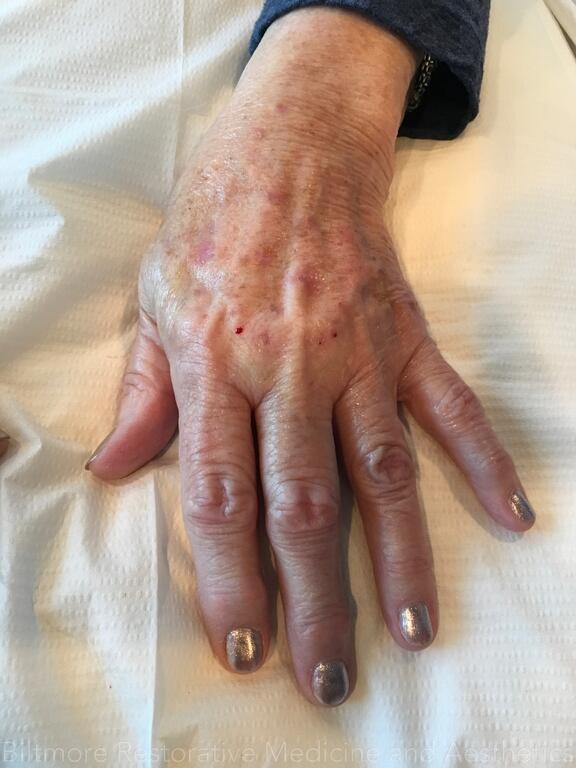 Hand Rejuvenation Before & After Image