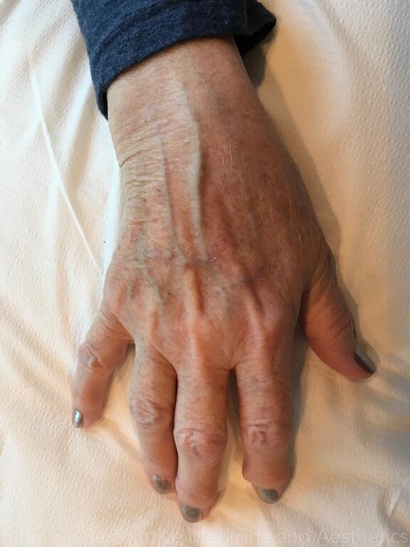 Hand Rejuvenation Before & After Image