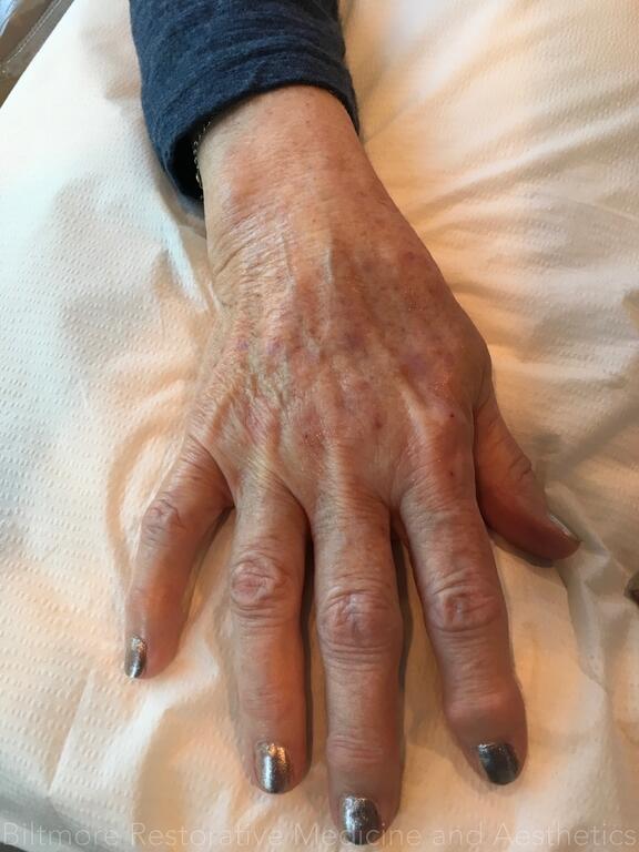 Hand Rejuvenation Before & After Image