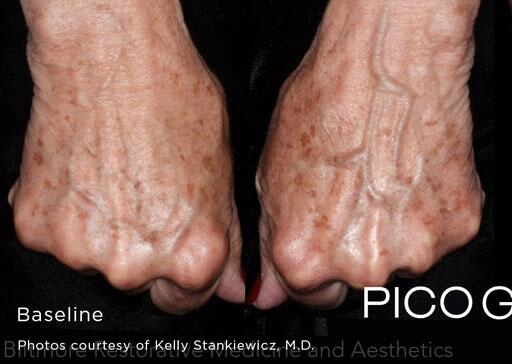 Hand Rejuvenation Before & After Image