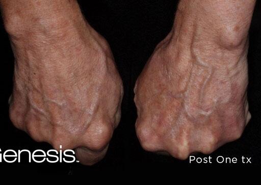 Hand Rejuvenation Before & After Image