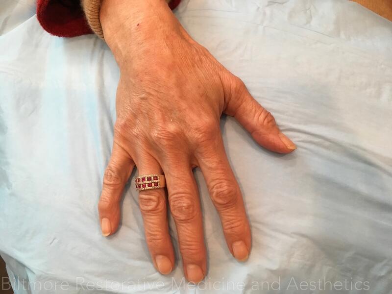 Hand Rejuvenation Before & After Image