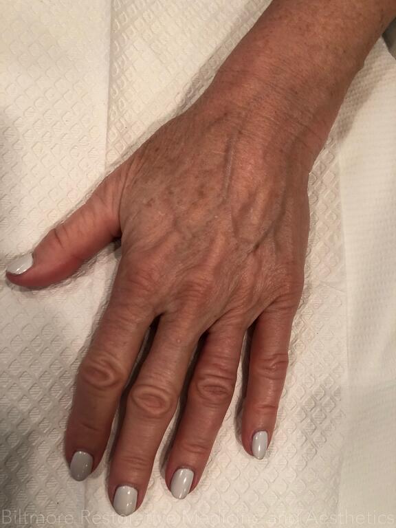 Hand Rejuvenation Before & After Image