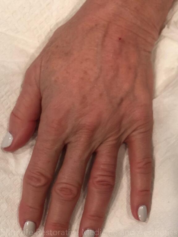 Hand Rejuvenation Before & After Image