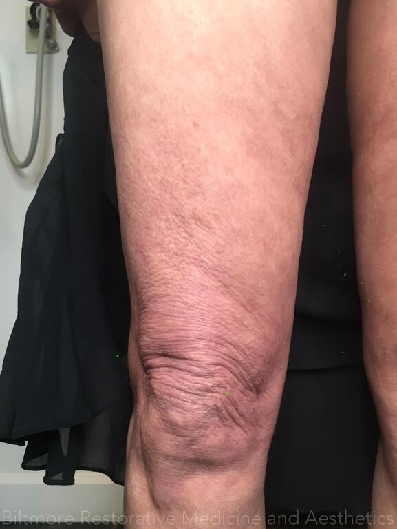 Threads Microneedling Knees Before & After Image