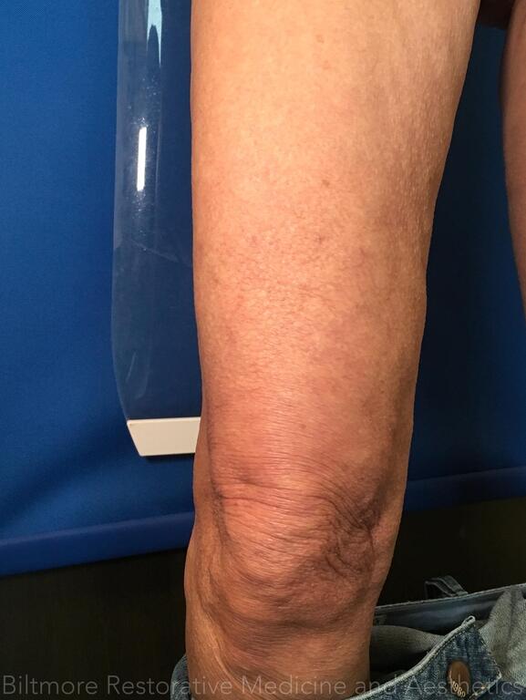 Threads Microneedling Knees Before & After Image