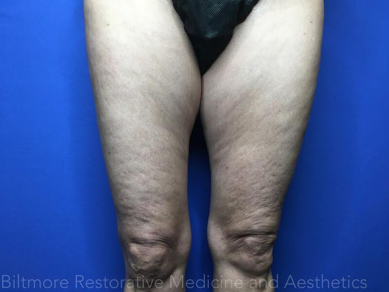 Threads Microneedling Knees Before & After Image