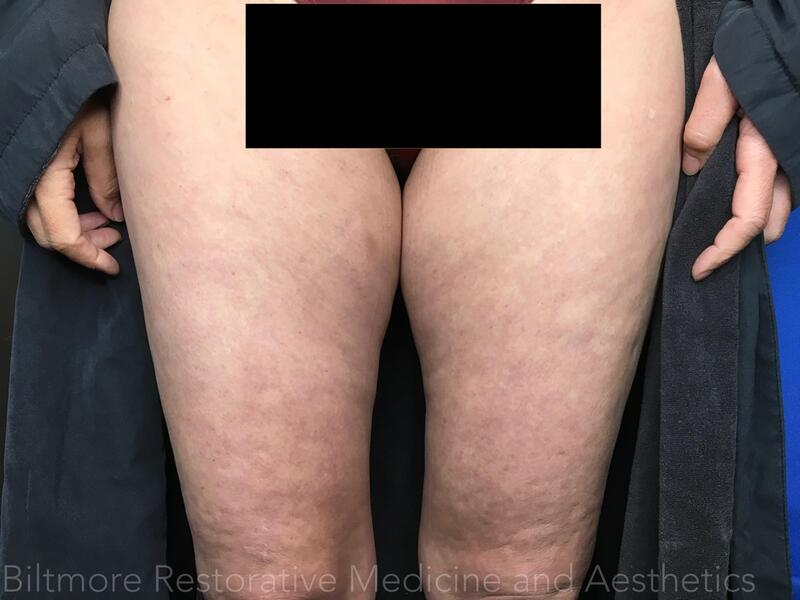 Threads Microneedling Knees Before & After Image