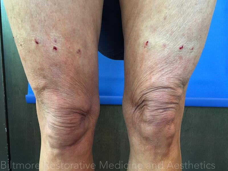 Threads Microneedling Knees Before & After Image