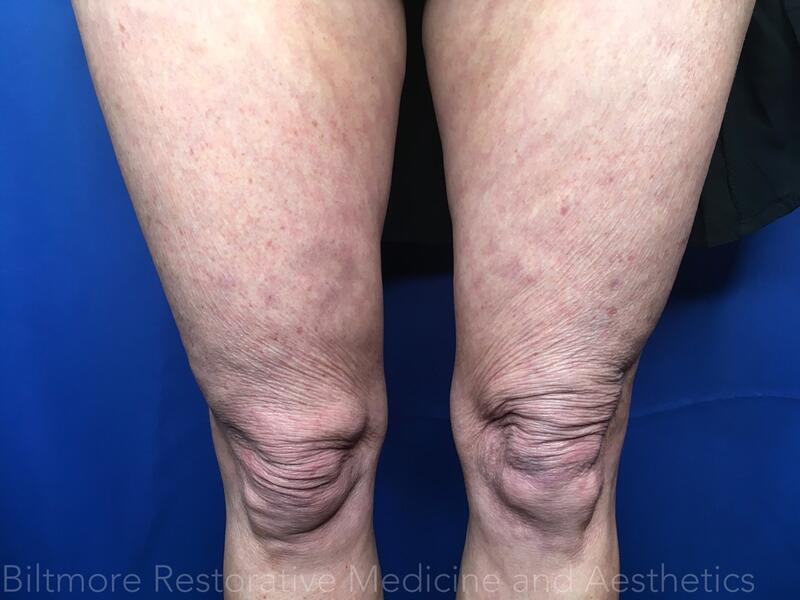 Threads Microneedling Knees Before & After Image