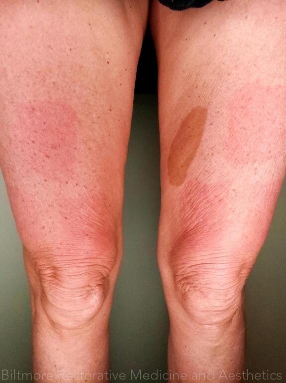 Threads Microneedling Knees Before & After Image