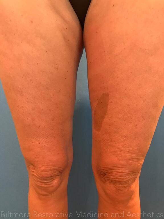 Threads Microneedling Knees Before & After Image