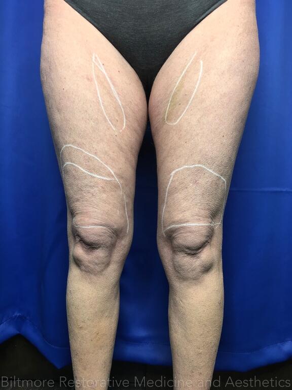 Threads Microneedling Knees Before & After Image