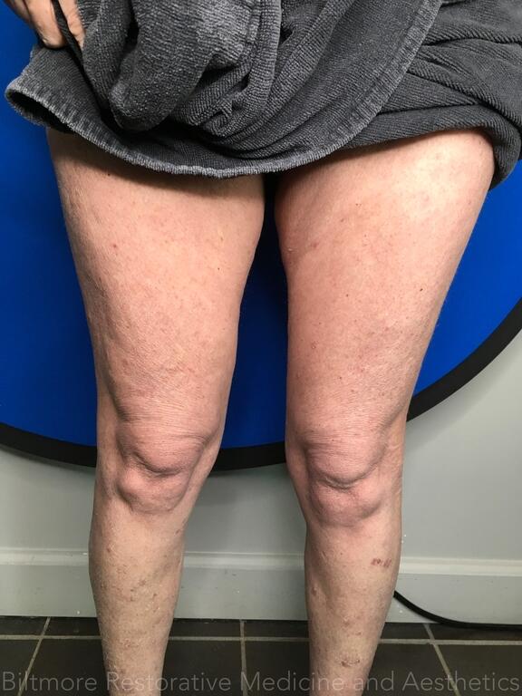 Threads Microneedling Knees Before & After Image