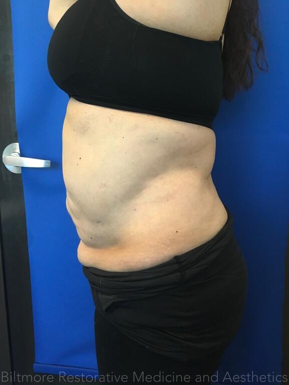 truSculpt ID Before & After Image