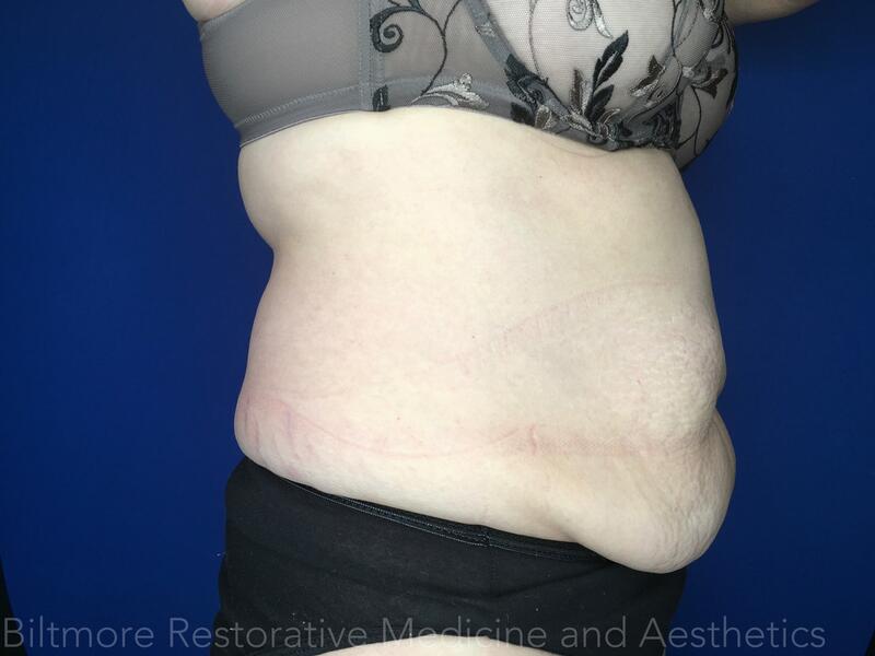 truSculpt ID Before & After Image
