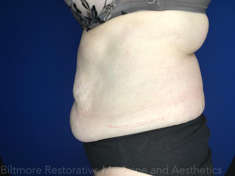 truSculpt ID Before & After Image