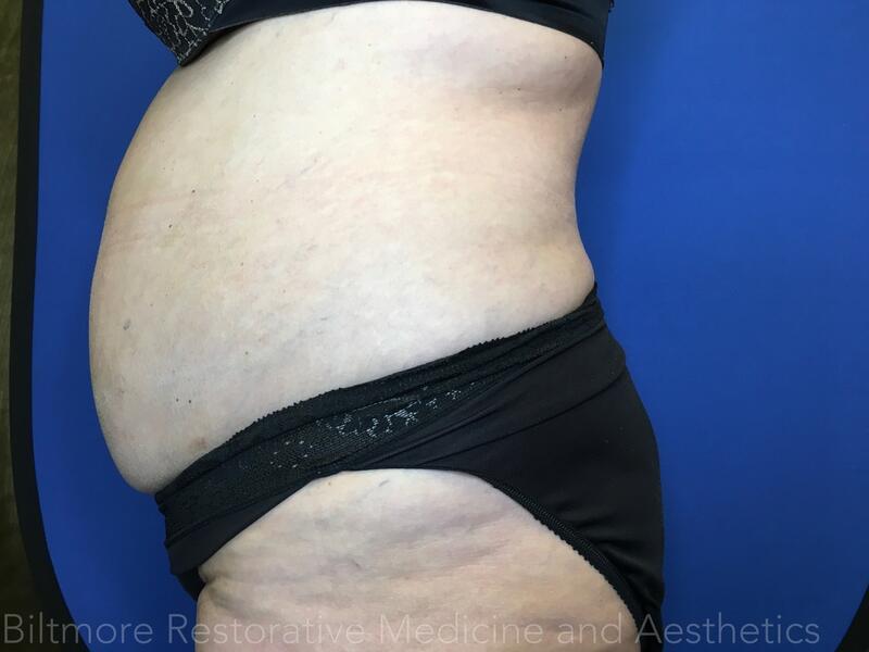 truSculpt ID Before & After Image