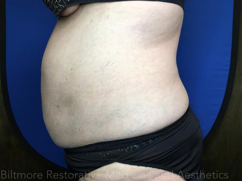 truSculpt ID Before & After Image