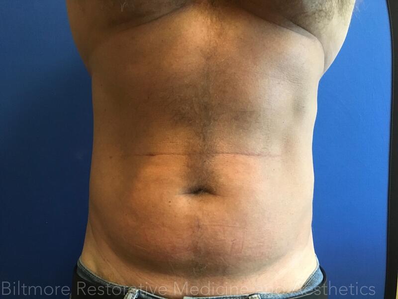 truSculpt ID Before & After Image