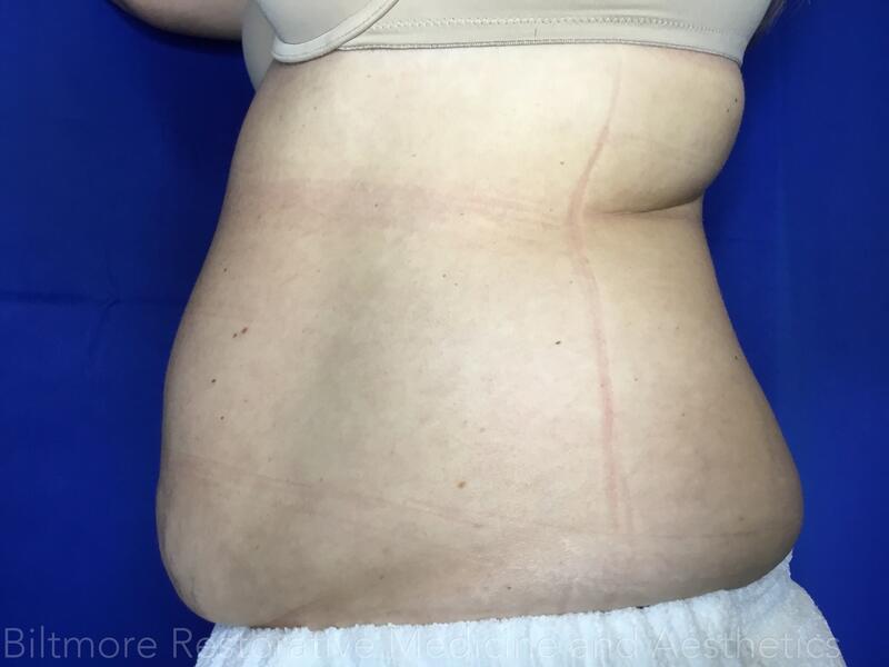 truSculpt ID Before & After Image