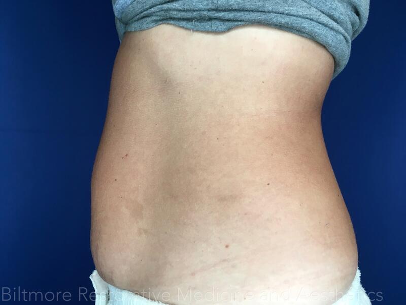 truSculpt ID Before & After Image