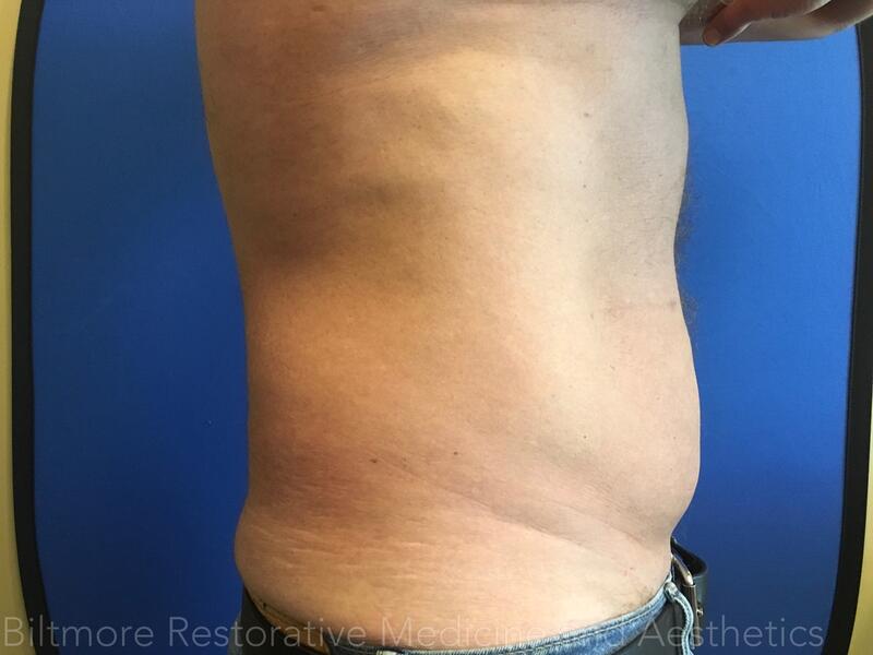 truSculpt ID Before & After Image