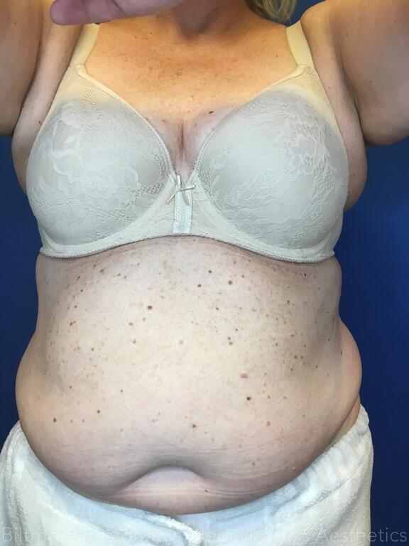 truSculpt ID Before & After Image