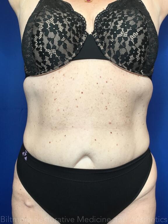 truSculpt ID Before & After Image