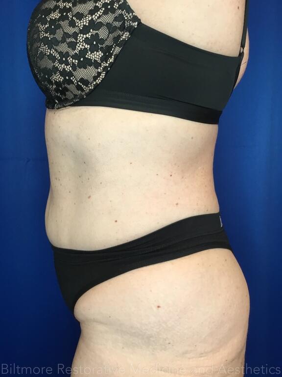 truSculpt ID Before & After Image