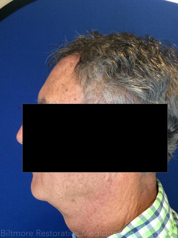 truSculpt ID Before & After Image