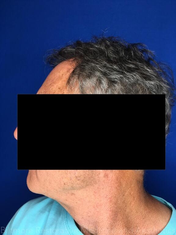 truSculpt ID Before & After Image