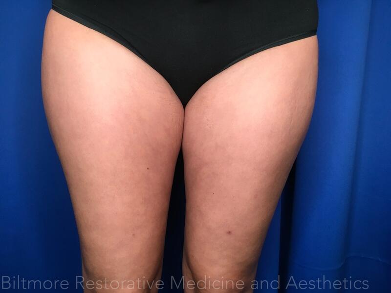 truSculpt ID Before & After Image