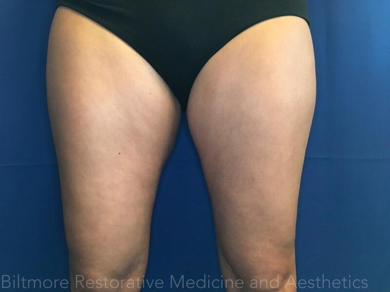 truSculpt ID Before & After Image