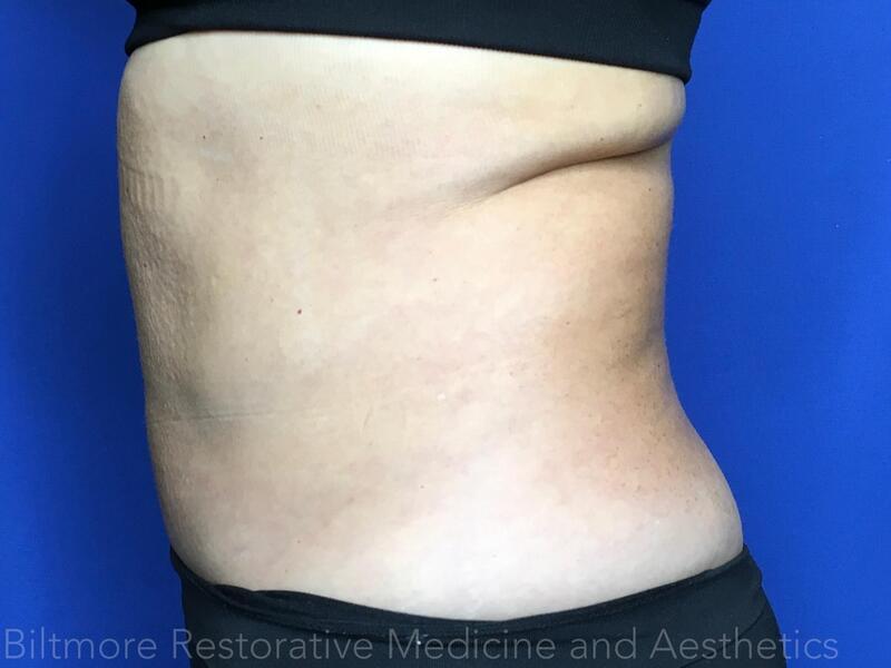 truSculpt ID Before & After Image