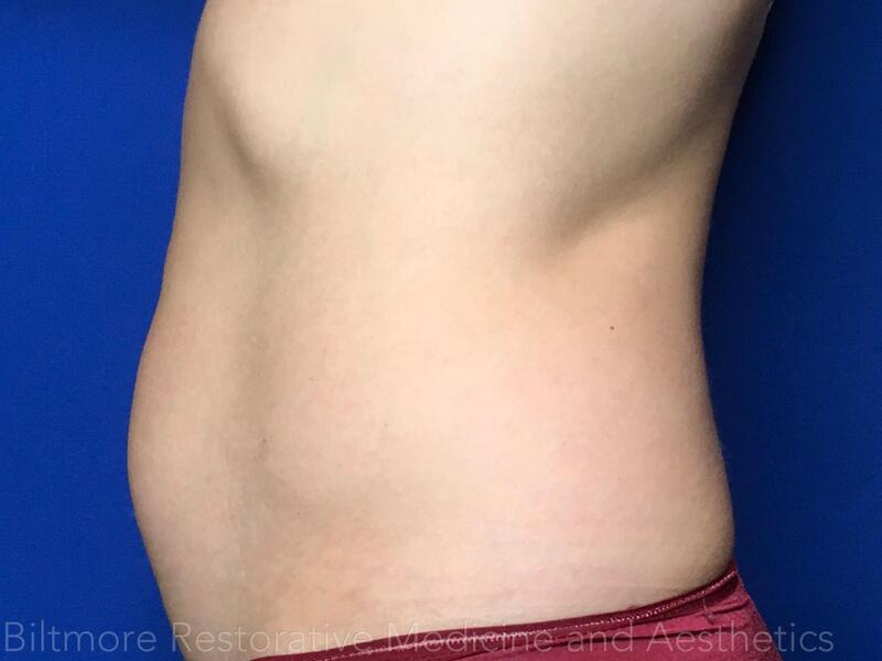 truSculpt ID Before & After Image