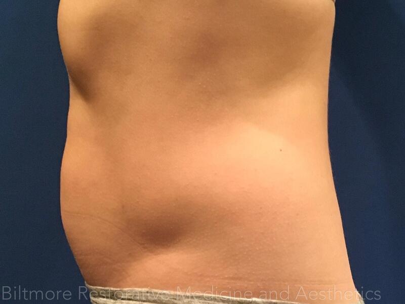 truSculpt ID Before & After Image