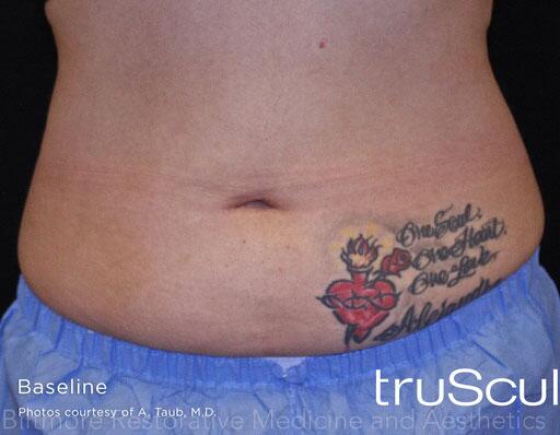 truSculpt ID Before & After Image